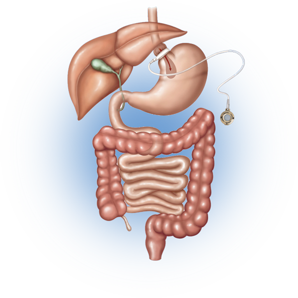 Your Ultimate Goal Of Weight Loss Surgery Is To Live - Vertical Sleeve Gastrectomy (596x595), Png Download