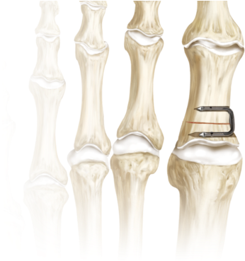 Quickfix Staple System 0 Large - Staple In Foot Bone Surgery (400x370), Png Download