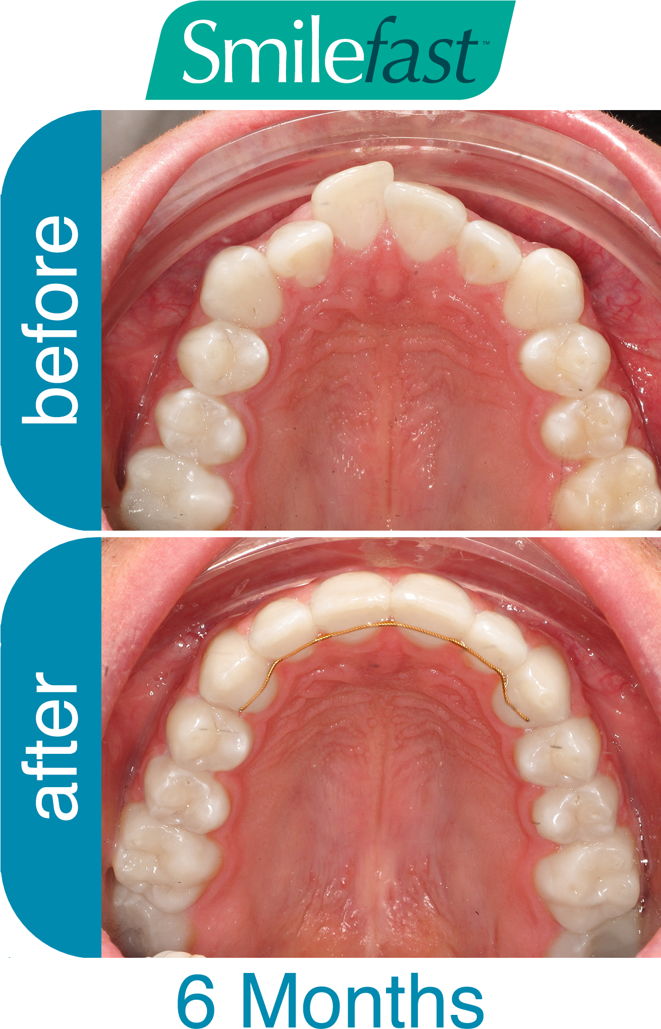 Aqd Smilefast After 6-months - Buck Teeth Smile Before And After Braces (1500x2100), Png Download