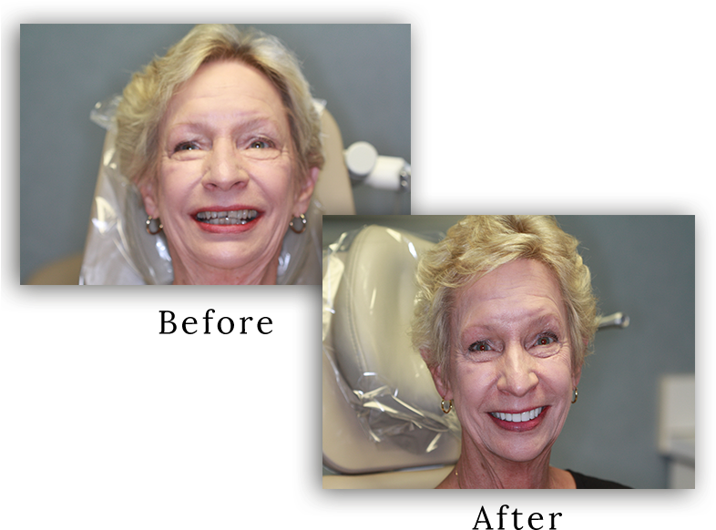 Dental Veneers Can Change Your Smile And Your Life - Senior Citizen (789x608), Png Download