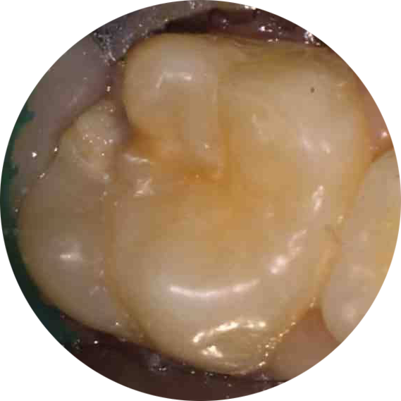 White Fillings - Before - Dental Restoration (569x569), Png Download