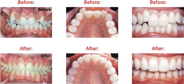 Braces, Teeth Misalignment, Tender Care Dental, Dental - Crowding Teeth (600x292), Png Download