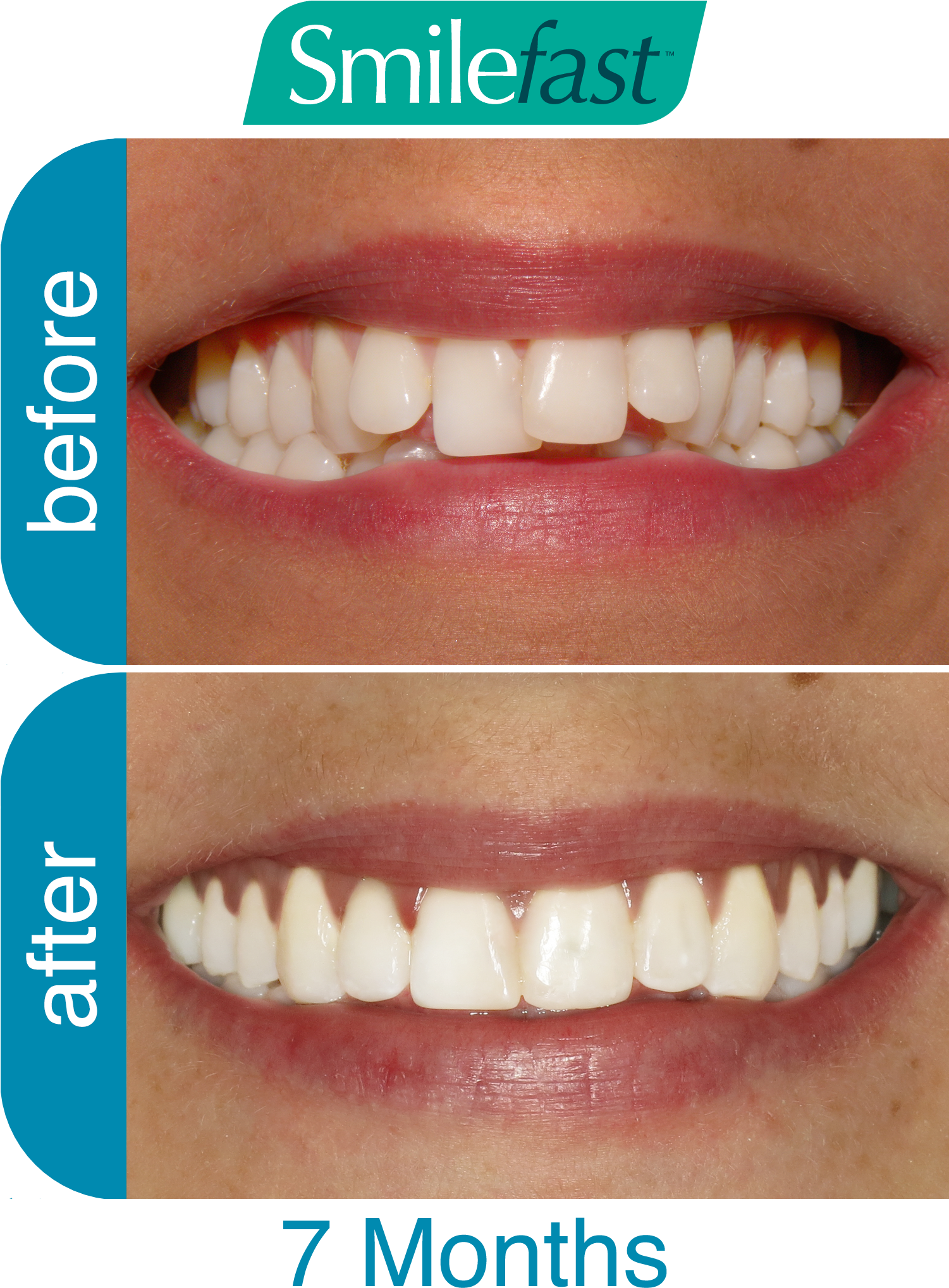 Aqd Smilefast After 7 Months2 Aqd Smilefast After 8 - Smilefast Before And After (1500x2100), Png Download