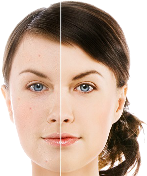Tea Tree Oil Eyebrows Before And After (786x350), Png Download