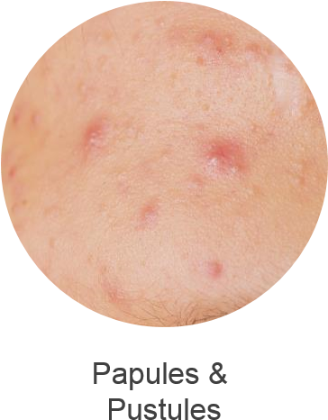 Is Associated With Pimples - Fruit (363x493), Png Download