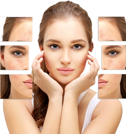 Acne Scars Removal For Women - Salicylic Acid Peel (415x600), Png Download