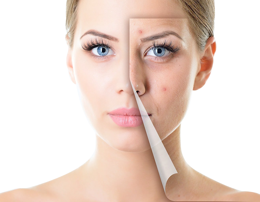 Acne Out Soap With Lactic And Salicylic Acid (912x707), Png Download
