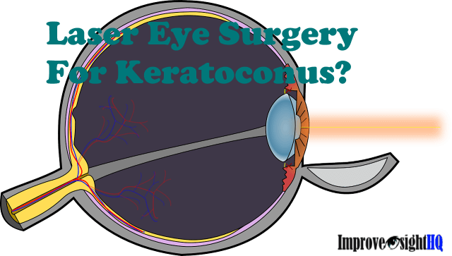 Laser Eye Surgery For Keratoconus - Keratoconus Treatment Laser (640x363), Png Download