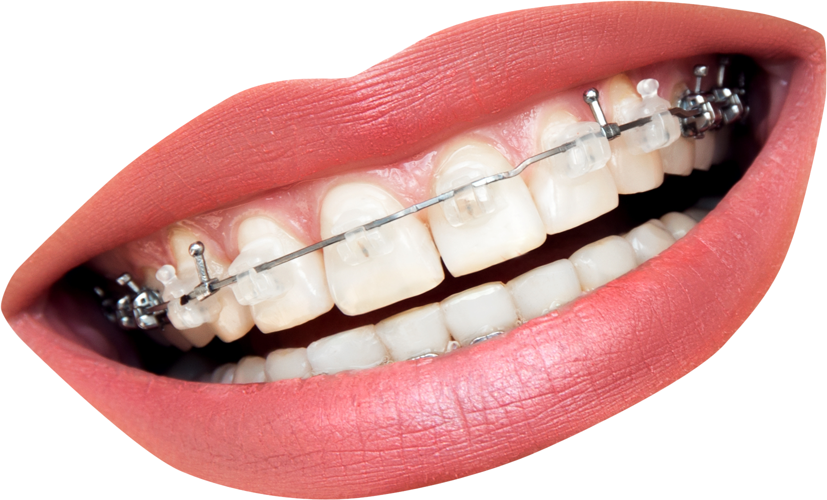 Transparent Mouth With Braces (1933x1558), Png Download