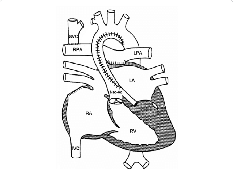 At The Time Of Bidirectional Glenn Procedure, The Gore-tex - Hypoplastic Left Heart Syndrome Mullins (761x555), Png Download
