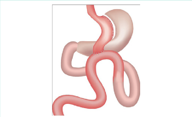 Mgb Created By Horizontal Division Distal To Crow's - Illustration (744x454), Png Download