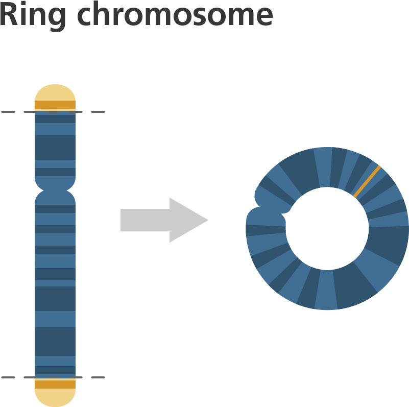 Balanced Vs Unbalanced Structural Abnormalities - Ring Chromosome (1076x956), Png Download