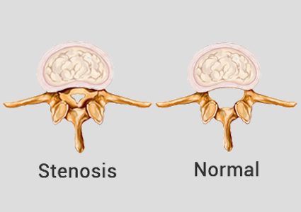 Spinal Stenosis - Spinal Stenosis Before And After (425x300), Png Download