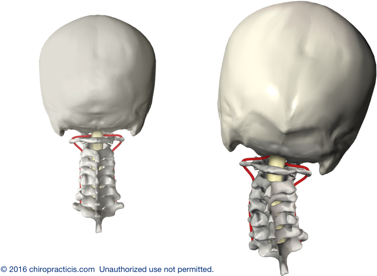 Vertebral Subluxation Newburyport Chiropractor - Subluxated Spine (800x566), Png Download