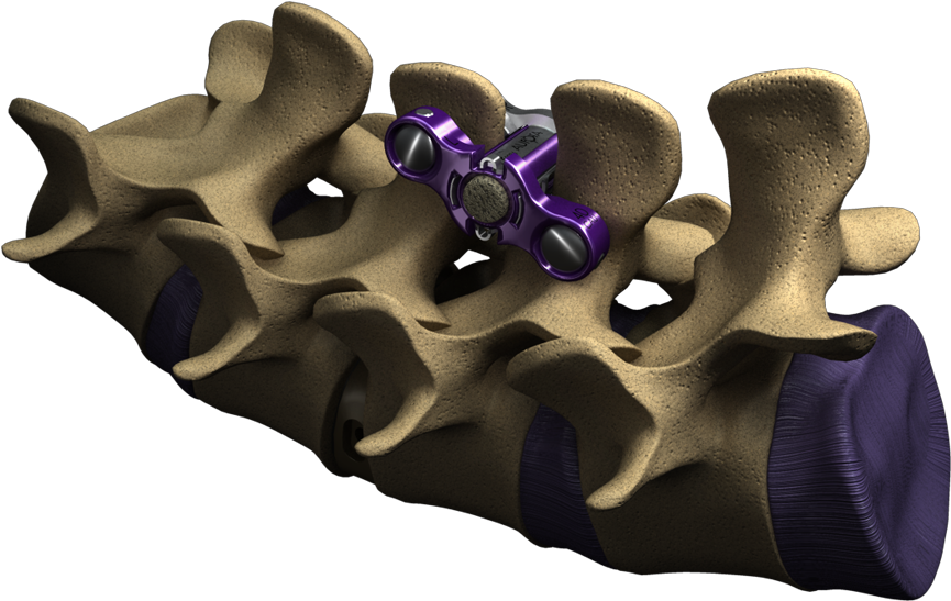 Spine Zipultra-1 - Interspinous Fusion Device (948x594), Png Download