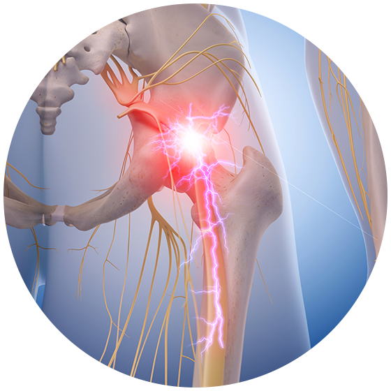 Therefore, When Something Goes Wrong During A Lumbar - Sciatic Nerve Pain (560x560), Png Download