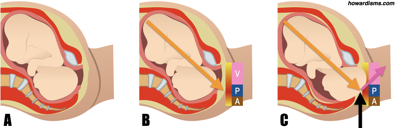 In The Illustration Above, We See In A A Baby Just - Perineal Trauma (1662x542), Png Download