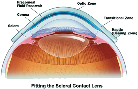 Scleral Contact Lenses - Intravitreal Injection (490x342), Png Download