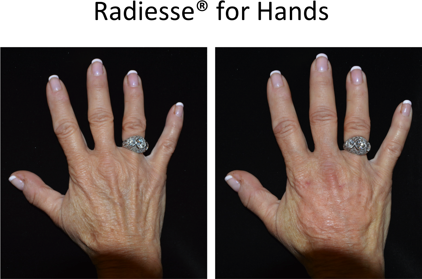 Before And After Radiesse For Hands - Filler In Your Hands (1350x960), Png Download