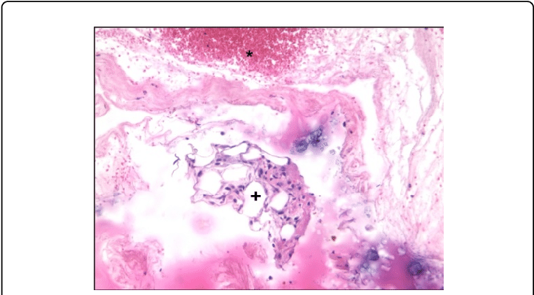 Histological View Of A Ruptured Achilles Tendon - Red Blood Cell (769x425), Png Download