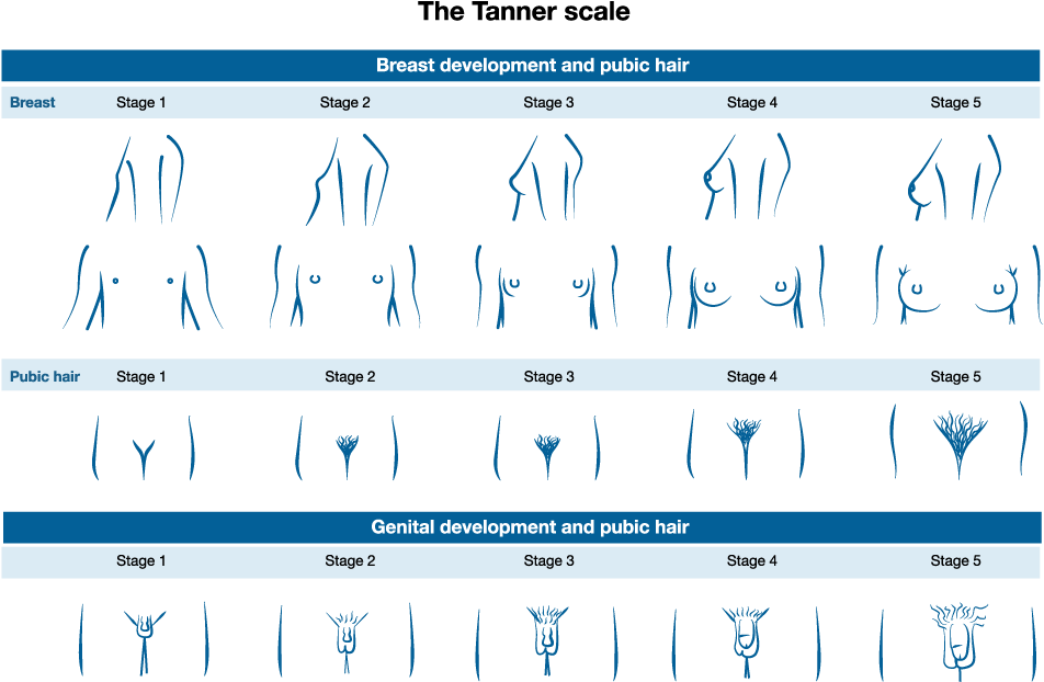 This Picture Depicts The Stages Of Pubic Hair, Genital, - Scales Of Tanner Of Breasts (1100x700), Png Download