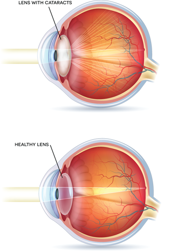 A Cataract Is The Clouding Of The Crystalline Lens - Cloudy Vision In One Eye (336x494), Png Download