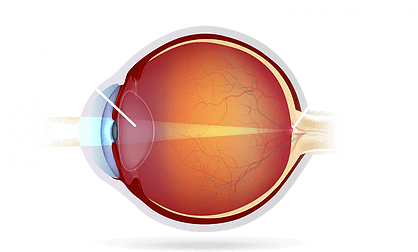 Normal Clear Lens - Globe (481x282), Png Download