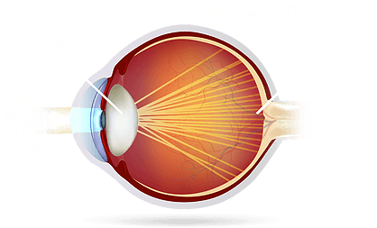 Cataract Clouded Lens - Circle (481x282), Png Download