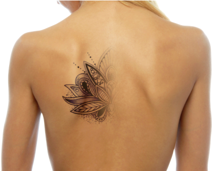 Tattoo-removal - Npm Tattoo Removal (435x340), Png Download