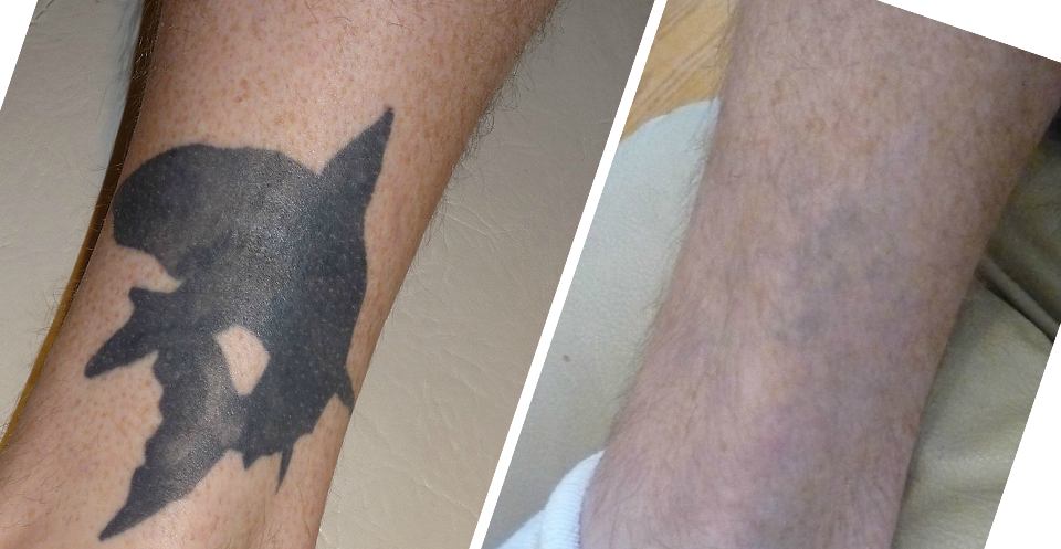 Lasers Work By Producing Short Pulses Of Intense Light - Laser Tattoo Fading (960x497), Png Download