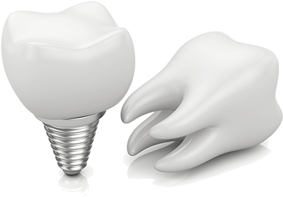 Dental Implants - Dental Implant (500x357), Png Download