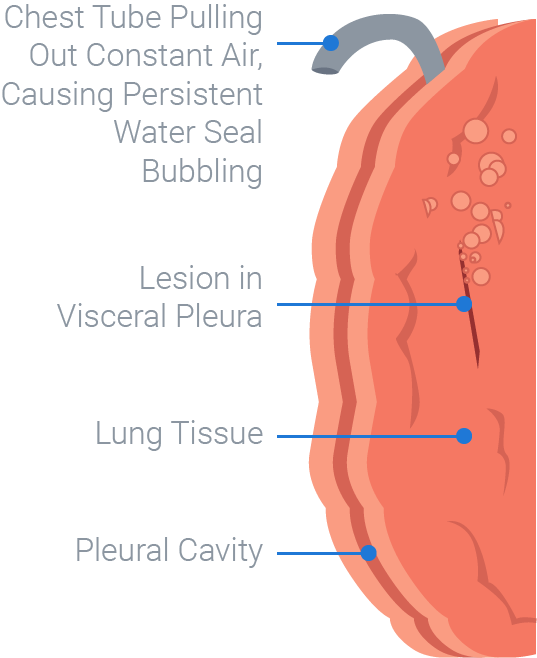 If Removing Excess Air Is The Goal Of The Chest Drain - Air Leak In Chest Tube (537x658), Png Download