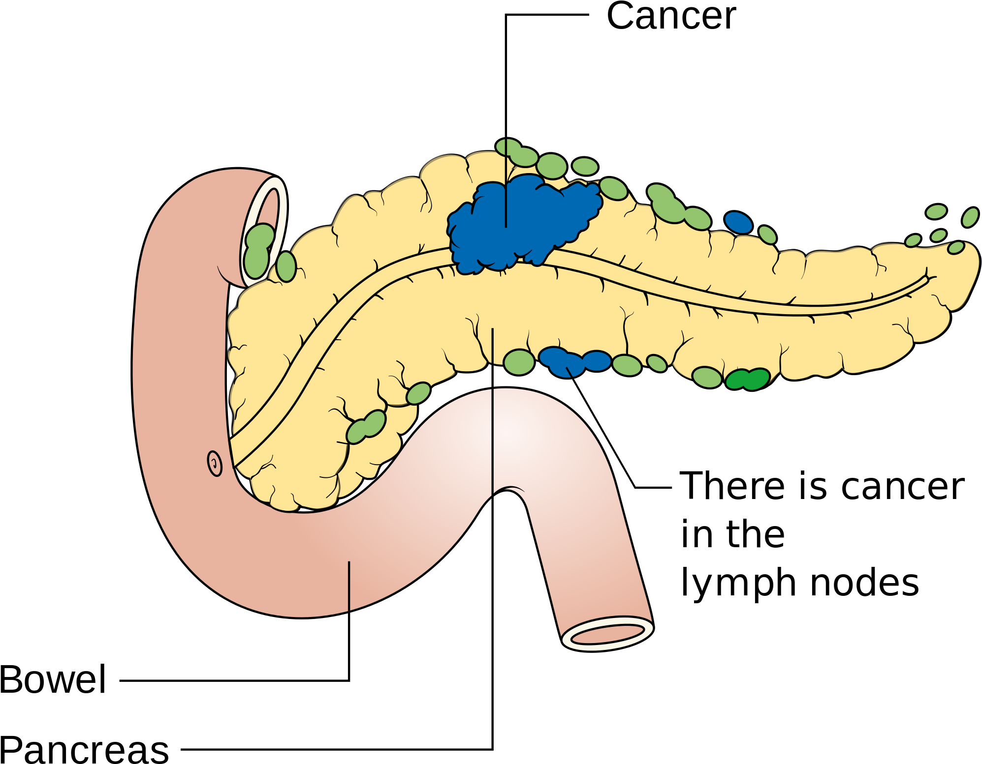 Source - Criticalhealthfacts - Com - Linfonodi Pancreas (2000x1592), Png Download