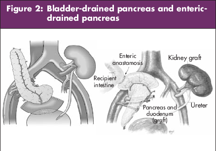 Bladder-drained Pancreas And Entericdrained Pancreas - Type 1 Diabetes (438x305), Png Download