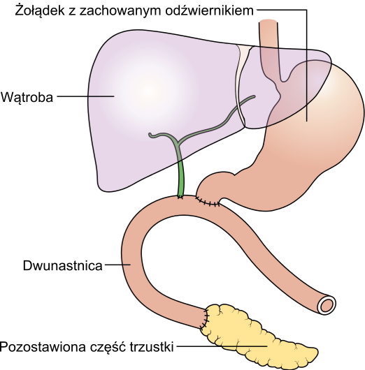 Diagram Showing The Pancreas Joined To The Small Bowel - Traverso Pancreas (522x530), Png Download