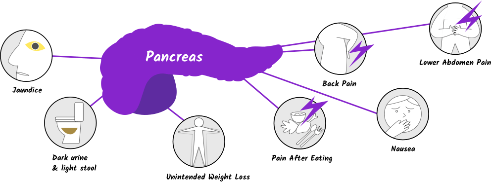 Pancreatic Cancer Symptoms With Seven Symptom Icons, - Pancreatic Cancer Diagnosis (992x369), Png Download