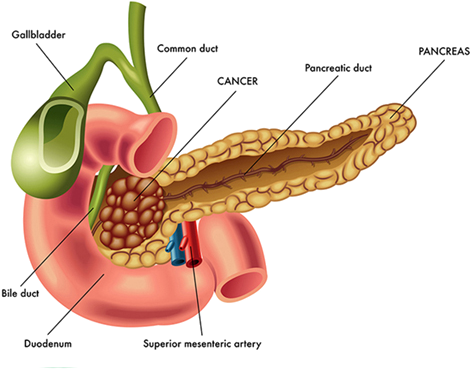 Ductal Adenocarcinoma Is By Far The Most Common Type - Pancreatic Cancer (498x400), Png Download