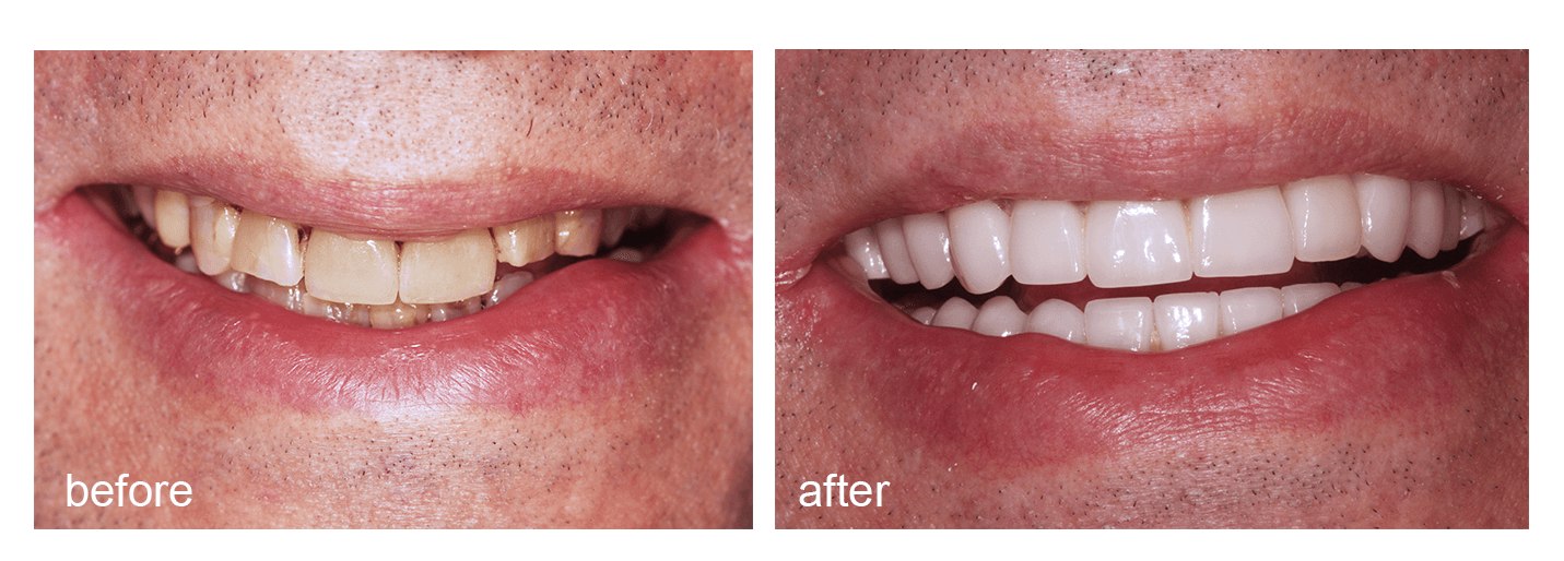 Shot Of Before And After Visiting Abington Smile Gallery - Aggression (1439x800), Png Download