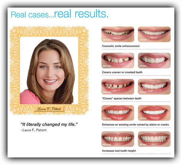 Snap On Smile - Snap On Smile Before And After (600x547), Png Download