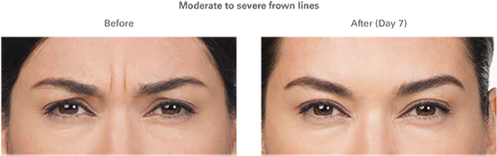 Ardmore Botox - Cosmetics (600x320), Png Download