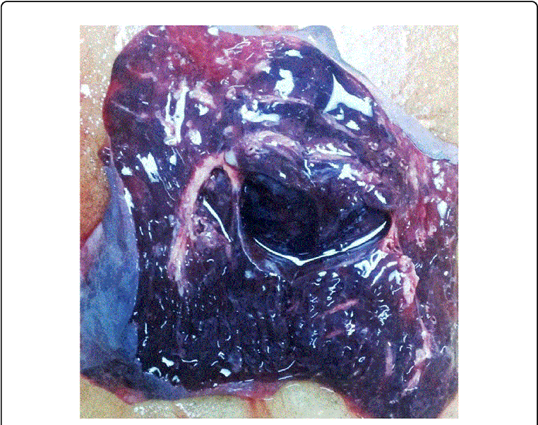 Extensive Pulmonary Hemorrhage - Fatal Pulmonary Hemorrhage Lung Cancer (769x605), Png Download