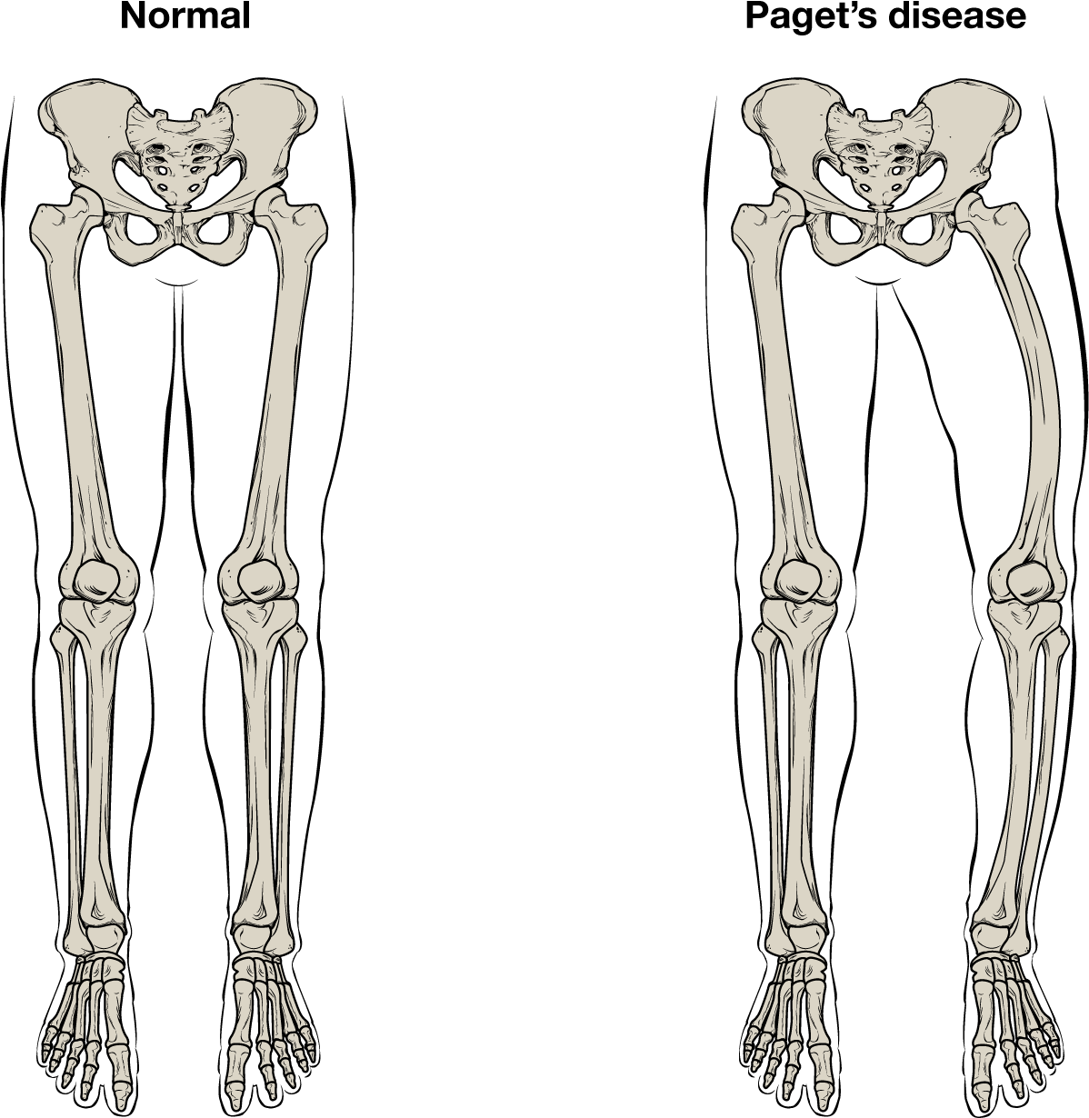 This Illustration Shows The Normal Skeletal Structure - Paget's Disease Of Bone (1205x1243), Png Download