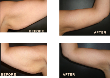 Arm34 - Arm Lift 6 Month Post Op (502x249), Png Download
