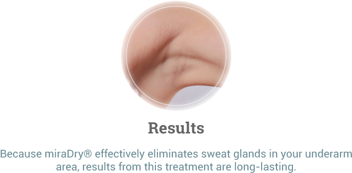 Miradry® Results - Retail Adventures (800x400), Png Download