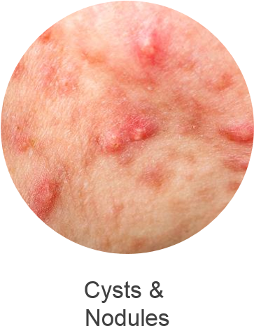 Comprises Blackheads Or Whiteheads Which Result From - Pluot (362x493), Png Download