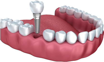 Why Patients Choose Dental Implants Over Dental Bridges - Denture Implant (450x301), Png Download
