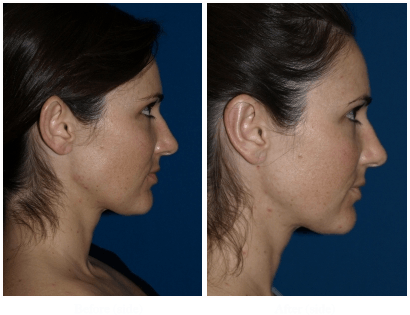 Ear Reshaping22 - Adult With Lop Ear (597x400), Png Download