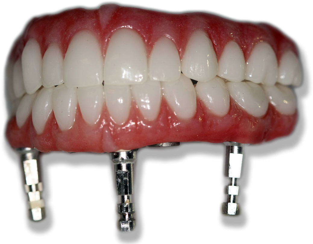 New Teeth In Just One Day - White Wolf Dental Group (1102x871), Png Download