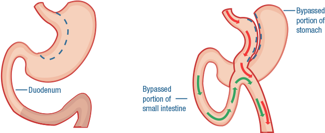 Bpd Ds Gastric Bypass - Biliopancreatic Diversion With Duodenal Switch Bpd (784x378), Png Download