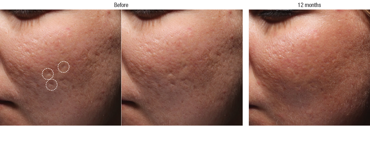 Bellafill Acne Scar Filler Photoset - Well Medical Arts (1264x485), Png Download